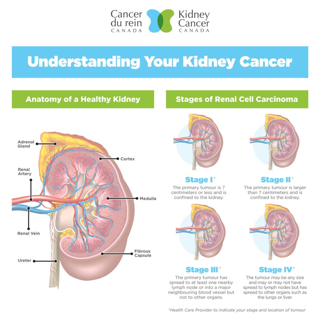 Understanding your kidney cancer